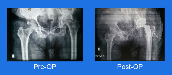 total-hip-replacement-with-post-traumatic-arthritis