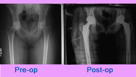 Bilateral Total Hip Replacement Sant Parmanand Hospital   Bilateral Total Hip Replacement 