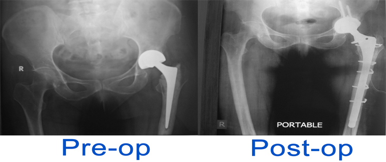 Conversion Of Bipolar To Total Hip Replacement Sant Parmanand Hospital 2671