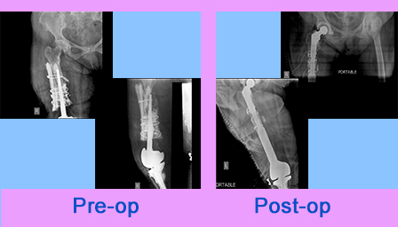 Total Femur Replacement with constrained Hip and Knee done | Sant ...