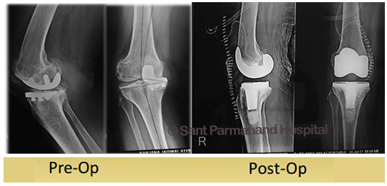 Uni Condylar To Total Knee Replacement Sant Parmanand Hospital