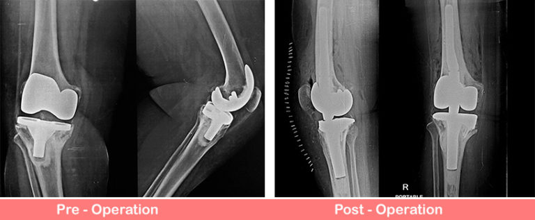 Revision Total Right Knee Replacement Sant Parmanand Hosptal